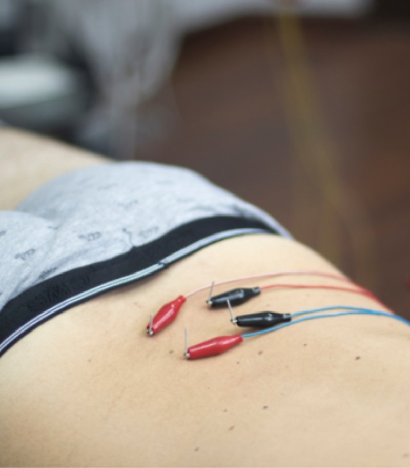 Punción ecoguiada con agujas y electrodos aplicados en la zona lumbar durante una sesión de fisioterapia invasiva en Kivnon Fisioterapia